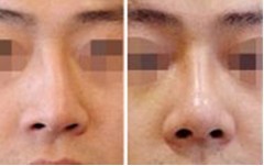 鼻頭調(diào)整案例——張先生