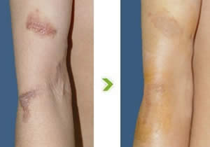 CO2激光之疤痕修復(fù)——叢先生