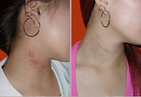 頸部疤痕修復(fù)——錢小姐