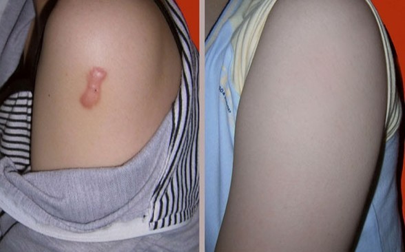 手臂疤痕修復(fù)——李女士