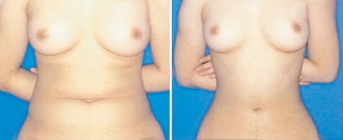 腹部疤痕修復(fù)——王小姐