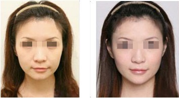 注射除皺——?jiǎng)⑴? /></a></div>
                        <span><h1><a href=