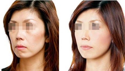 愛(ài)貝芙注射除皺——毛女士