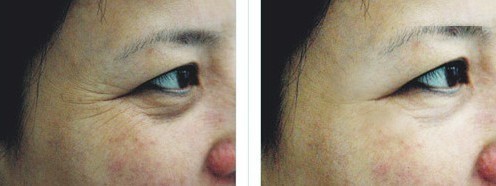 注射去除魚(yú)尾紋——吳女士