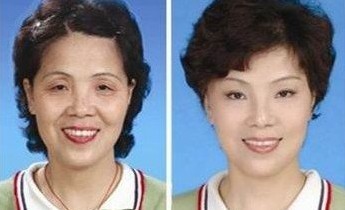 botox注射除皺——潘女士