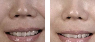 注射去除鼻唇溝——丁女士