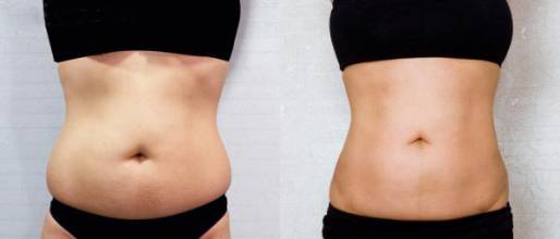腹部吸脂.jpg
