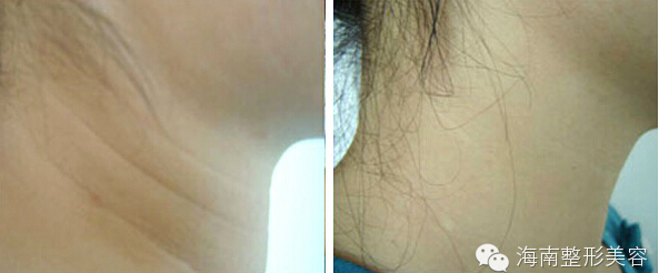 海南整形除頸紋.jpg