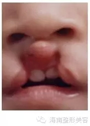 唇腭裂.webp.jpg