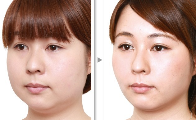 面部吸脂——田小姐