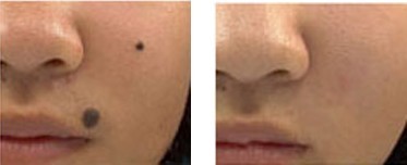 激光去痣——李小姐