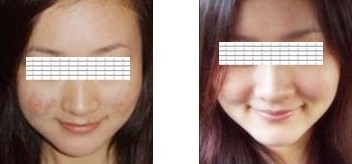 激光祛痘——周小姐