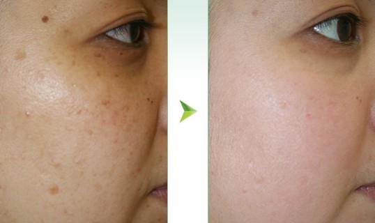 激光去斑——?jiǎng)⑴? /></a></div>
                        <span><h1><a href=