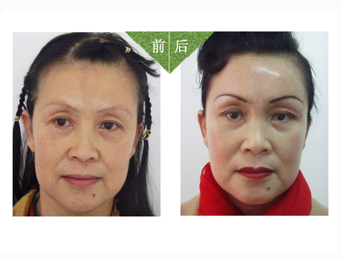 注射愛貝芙除皺——謝女士