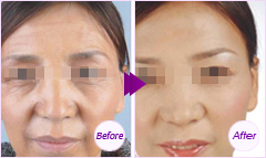 脂肪干細(xì)胞面部種植——?jiǎng)⑴? /></a></div>
                        <span><h1><a href=