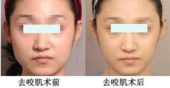 去咬肌整形手術(shù)——范女士