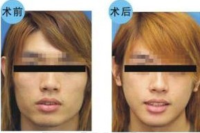 下頜角整形——鄭先生