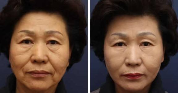 面部除皺.jpg