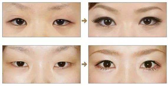 內(nèi)眥贅皮手術(shù).jpg