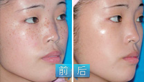 飛頓570之祛除先天性雀斑——郝小姐