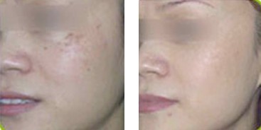 激光祛斑——張女士