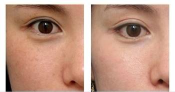 去雀斑——范小姐