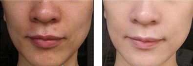 激光去黃褐斑——劉小姐