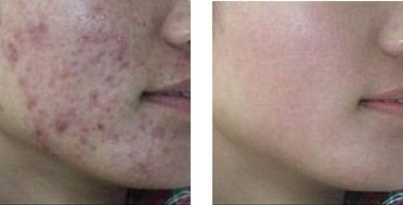 激光祛痘——吳女士