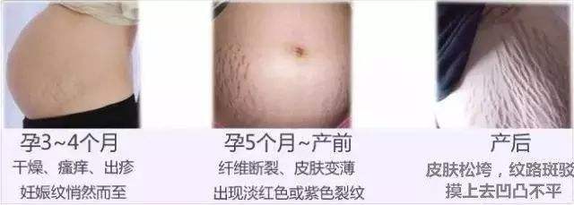 妊娠紋.jpg