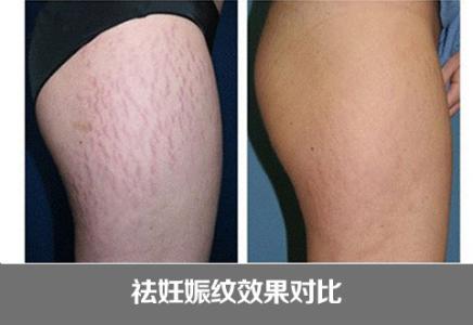 去妊娠紋效果.jpg