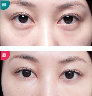 激光去眼袋.jpg