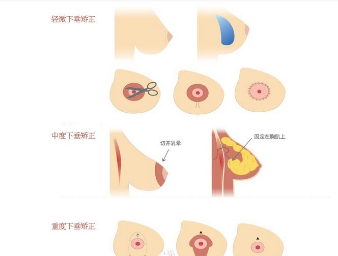 矯正乳房下垂.jpg
