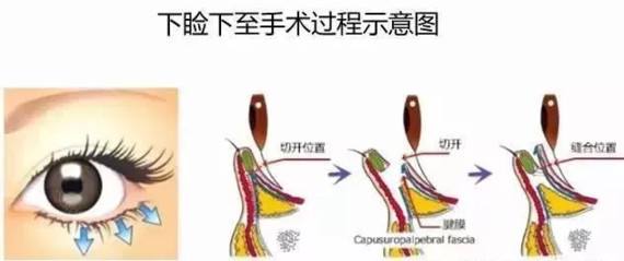 上瞼下垂.jpg