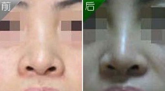 隆鼻手術(shù)失敗修復(fù)——劉小姐