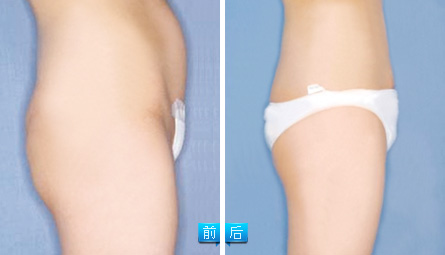 腰腹部吸脂——王小姐