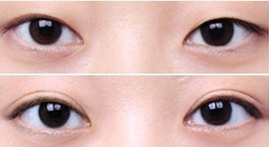 眼部整形手術(shù)案例——吳女士
