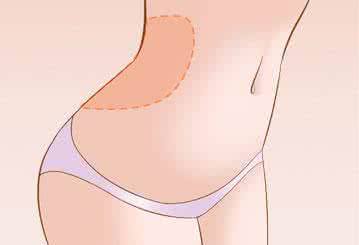 腰部吸脂示意圖-林賢超醫(yī)生